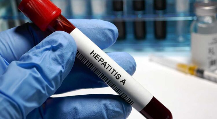 Aumentan casos de Hepatitis “A”