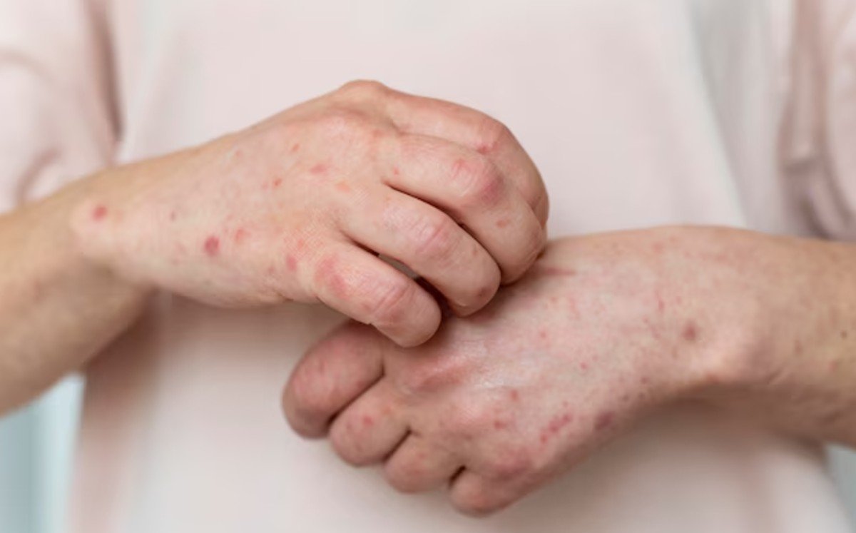 En aumento los contagios de sarampión en Durango