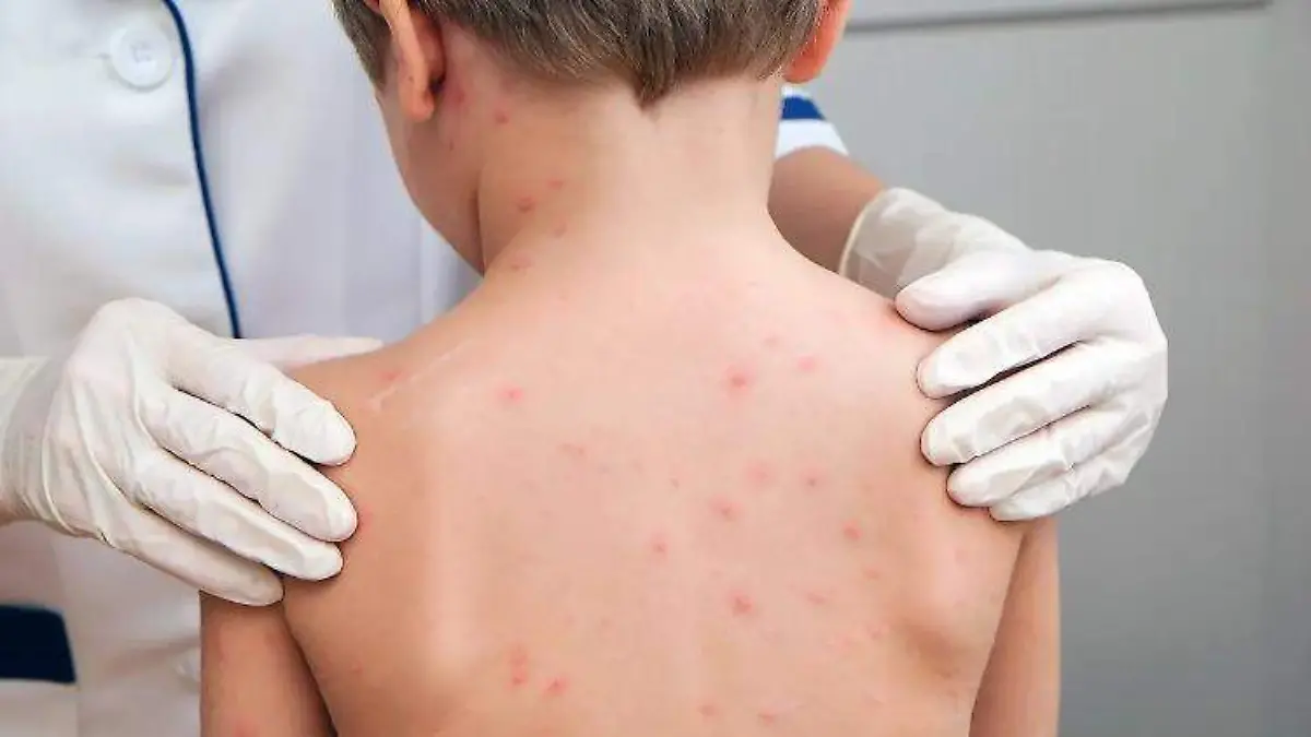 Suben a 189 los casos de sarampión en Durango; Gómez Palacio reporta mayor incidencia municipal